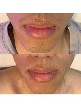 ロカヒ(Lokahi)/ヒゲ脱毛4回