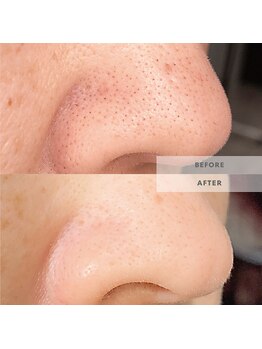 ウルス(ulus)/ハイドロフェイシャル