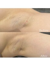 ソワン(Soin)/女性　ワキ脱毛１回