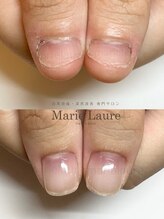 マリーロール 淀屋橋本店(Marie Laure)/自爪育成/深爪矯正/ネイルケア