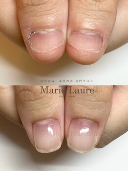 マリーロール 淀屋橋本店(Marie Laure)/自爪育成/深爪矯正/ネイルケア
