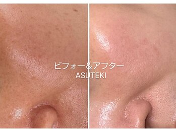 アステキ(ASUTEKI)/ハーブピーリング【剥離なし】