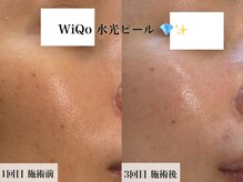 ウィ アネラ(U'i Anela)/WiQo水光ピール