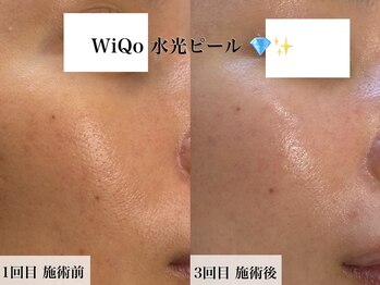 ウィ アネラ(U'i Anela)/WiQo水光ピール