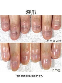 20代/深爪/半年後アフター