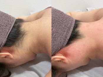 キカ(kika)/うなじワックス＋美容脱毛