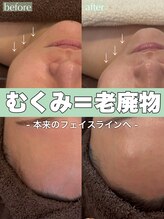 ジェノール 飾磨本店(JNOEL)/それは脂肪ではなくむくみかも？