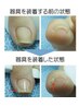 【最先端！フット巻爪補正】お試し★クリアコーティング仕上げ￥　3300