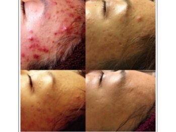 アディス 心斎橋(ADISE)/ニキビが気になる方へ