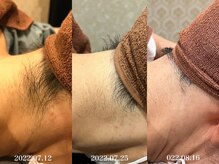 ウルル 栄店(ULULU)/えりあし脱毛の症例♪