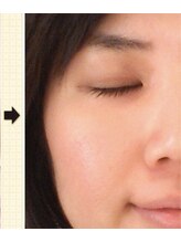 ノットノット 自由が丘(Not Knot)/２.グリーンピール 5days 14日後