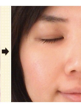 ノットノット 自由が丘(Not Knot)/２.グリーンピール 5days 14日後