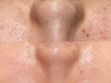 ビジュープラス 広島店(Bijou+)/【20代/毛穴黒ずみ、開き毛穴】