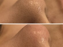 エントテ(en to Te)/毛穴詰りと産毛のような角栓ケア