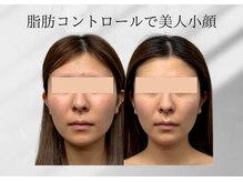 アールメディカルサロン 富山院(R Medical Salon)/ヒアルリッチ導入