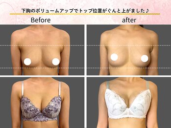 ロットプラス(Lot Plus)/バストアップ症例【E→Hカップ】