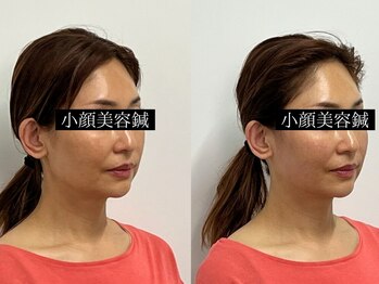 コガオ レンネ(Lenne)/フェイスラインスッキリ♪