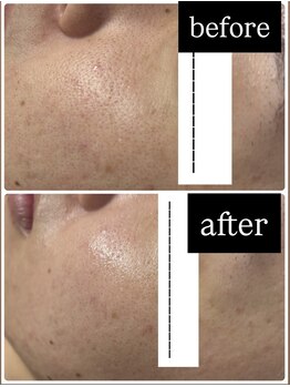 ジョリベル(JoliBelle)/ビフォーアフター