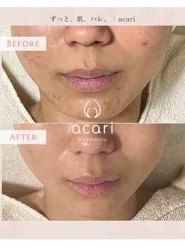 アカリ(acari)/繰り返すニキビ/頑固な跡