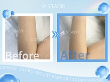 ストラッシュ アリオ加古川店(STLASSH)/施術例：ひじ下