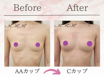 メディカルサロン エム エム エム 大阪梅田グランドサロン(M.M.M)/【バストアップ例】AA→Cカップ