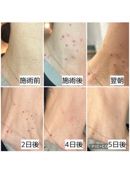 ナンバーナイン(No.9)/ピグメンテーションデトックス