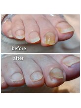 爪切り屋 足楽/爪溝鶏眼