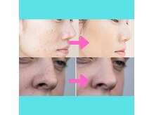 毛穴洗浄によって脱毛の効果を高めます！フェイシャルにも効果有