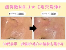 ウル 下北沢(Ulu)/韓国式３D毛穴洗浄