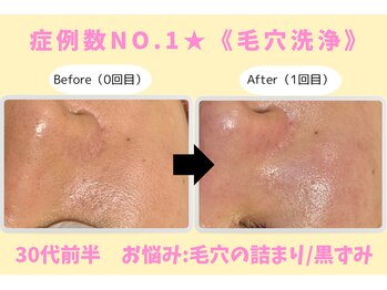 ウル 下北沢(Ulu)/韓国式３D毛穴洗浄