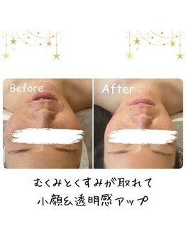 かれん/ハイパーナイフ小顔ケア