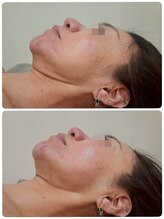 美ネージュ/たるんだお肌にレモンボトル