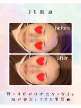 リリアン(lirien)/毛穴/毛穴ケア/毛穴洗浄/駒込