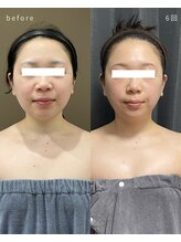 レクシア(LEXIA)/小顔ケア症例｜PRO LIFT 6回目