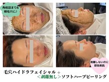 ハーシークレット(Her secret)/毛穴洗浄＋ハーブピーリング