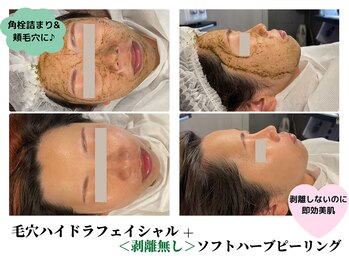 ハーシークレット(Her secret)/毛穴洗浄＋ハーブピーリング