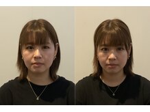 小顔矯正整体サロン イクサス(IxAS)/初回での<before&after>