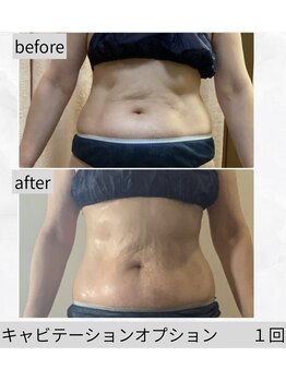 ヴィオテラス(VIOTERACE)/NEW★キャビテーション１回