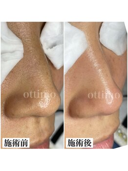 オッティモ(ottimo)/毛穴エクストラクションプロ