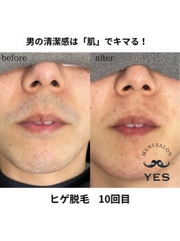 イエス 佐賀店(YES)/ヒゲ脱毛ビフォーアフター