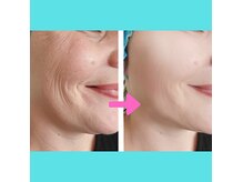 BBLによってお肌をふっくら仕上げます！シミやシワをケアします