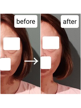 エルアンドエス(L&S)/本気なら短期集中＆体の鍼を追加