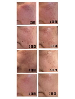 イロドリ(irodori)/本格肌改善ガリレオピーリング☆