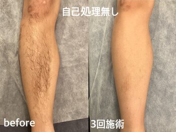 ヴィセラ(Vicella)/高校生男子