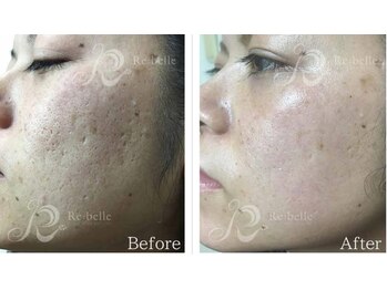 カノン(Kanon.)/リベルハーブピーリング