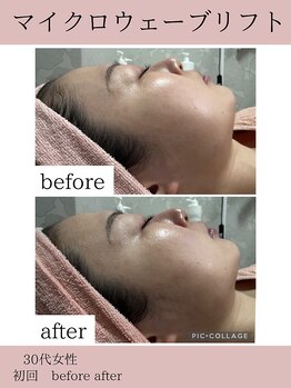 ココ(COCO)/マイクロウェーブリフト/小顔
