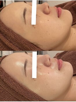 ミベル(MeBell)/セラピール×毛穴洗浄