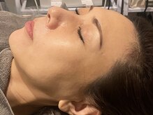 ラルミエール 緑店はなれ(la lumiere)/肌質改善！リゼネレート