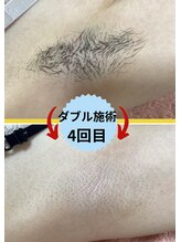 ディスイズミー シュガーリング(This is me Sugaring)/【ダブル】生えてくる毛が細い