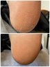 足裏角質ケア